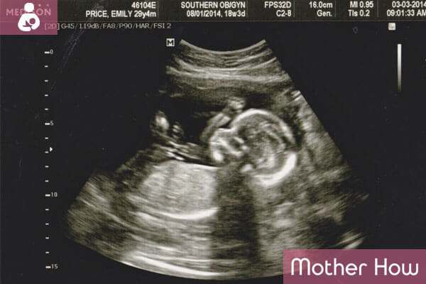 18-weeks-ultrasound