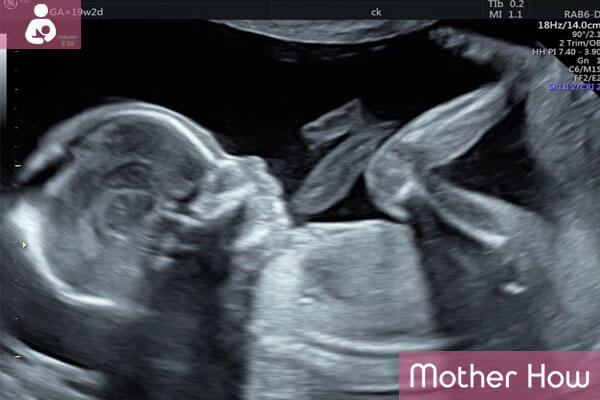 19-weeks-ultrasound