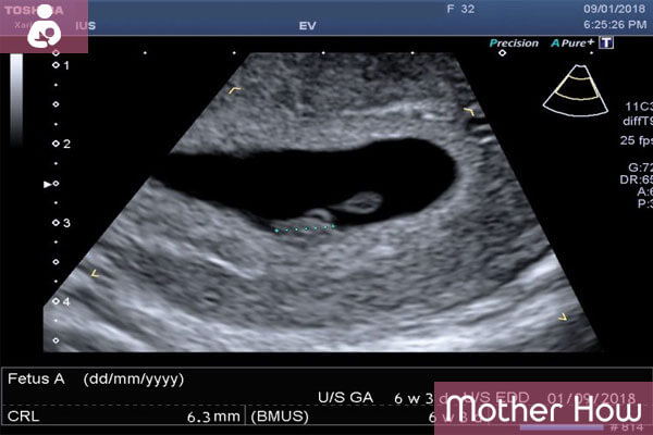 6-weeks-ultrasound