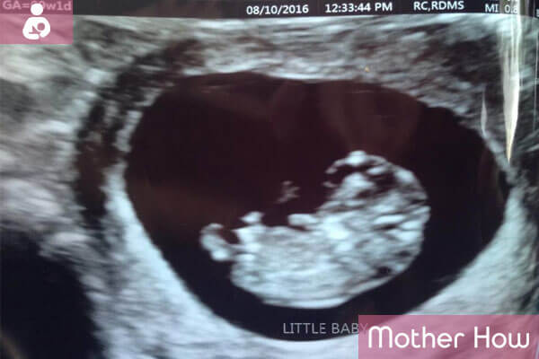 9-weeks-ultrasound