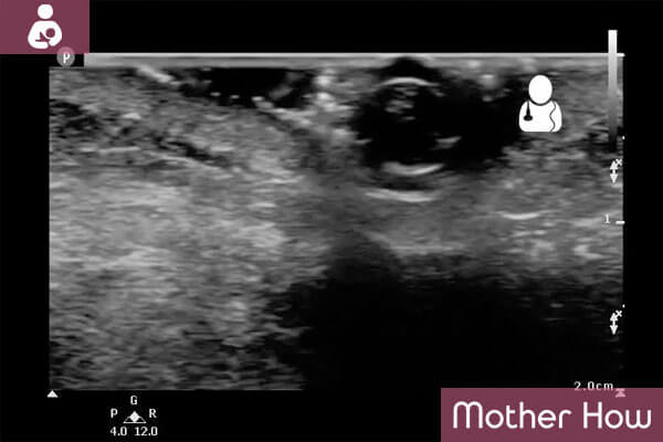 MotherHow-3-weeks-ultrasound