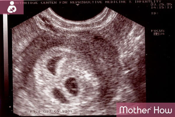 MotherHow-4-weeks-ultrasound