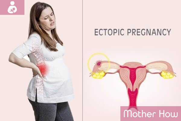 women-ectopic-pregnancy