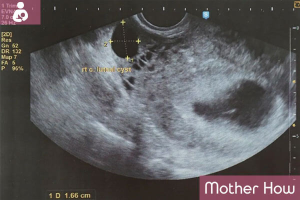 1-month-pregnant-ultrasound