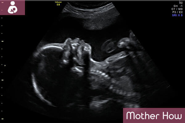24-weeks-ultrasound
