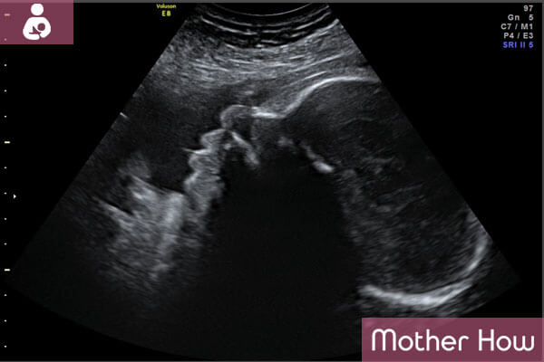 35-weeks-ultrasound