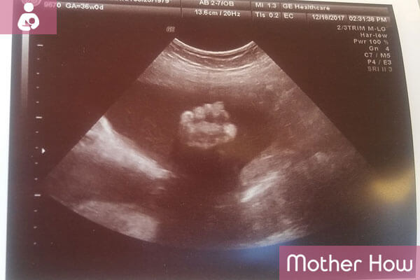 36-weeks-ultrasound