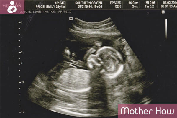 4-month-ultrasound