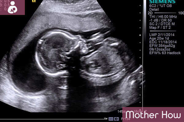 41-weeks-ultrasound