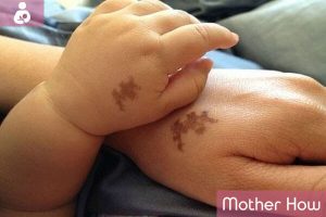 Baby-Birth-marks