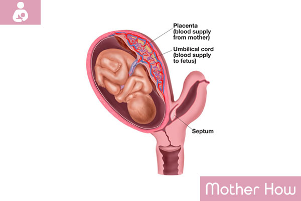 Bicornuate-Uterus-Symptoms