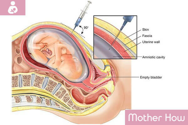 Diagnostics-Of-Stillbirth