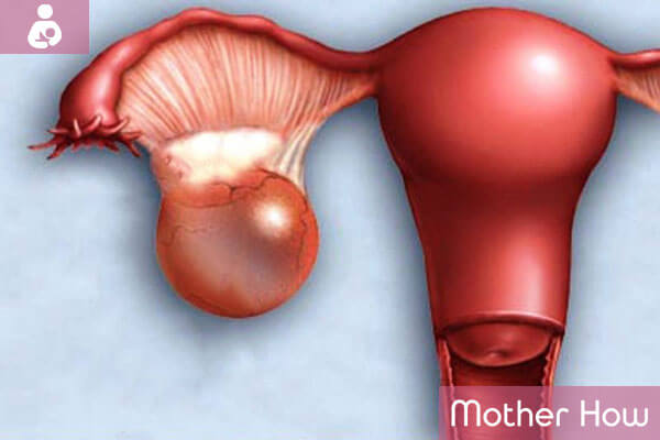 Ovarian-Cyst