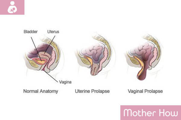 Uterus-Symptoms