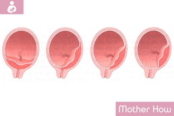 Variations-Of-Placenta-Previa