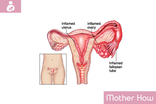 inflammation-of-ovaries