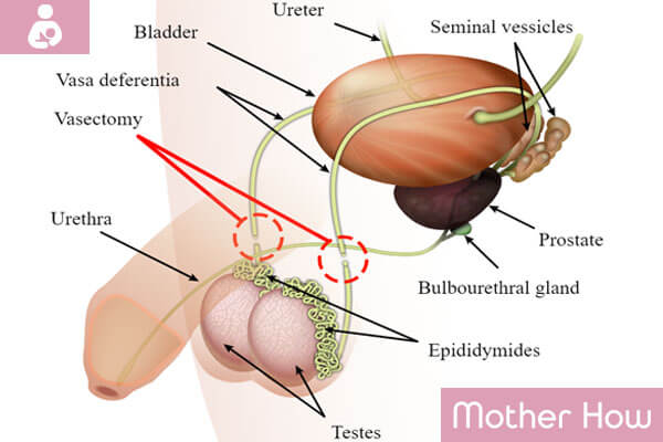 Diagram of Vasectomy