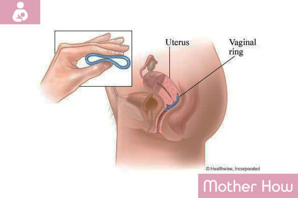 Vaginal-Ring
