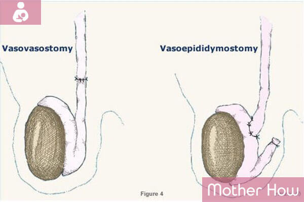 Vasovasostomy-and-Vasoepididymostomy