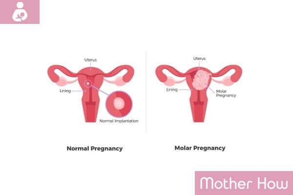 Molar-Pregnancy-symptoms